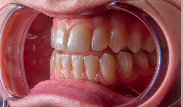 Root Canal