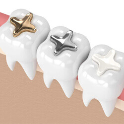 Full Mouth Rehabilitation